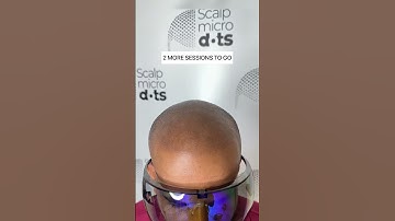 SCALP MICROPIGMENTATION in India, 8891426652 8078800335 #sca #scalpmicropigmentation #alopeciaareata