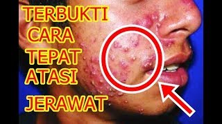 JERAWAT HILANG TUNTAS! 5 CARA MENGHILANGKAN JERAWAT DALAM 1 MALAM TANPA BEKAS!