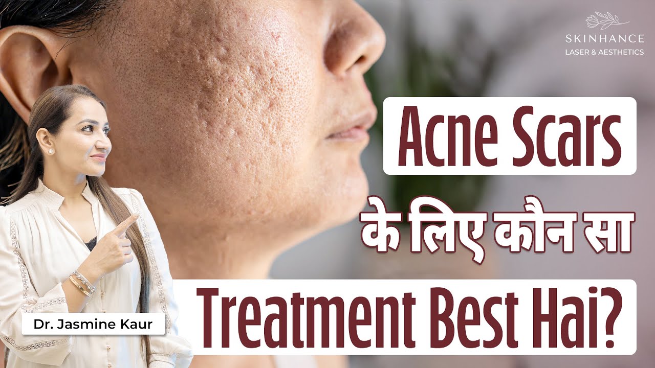 Acne Scars Treatment | Microneedling vs Laser for Acne Scars | Cosmetologist In Patiala