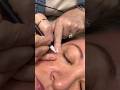 Cherry Angioma Removal рџЌ Cherryangioma Beauty Pmu Cherry Angioma Removal рџЌ Cherryangioma Beauty Pmu