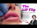 The Lip Flip What it is and When to Use it Lip Injections Portland