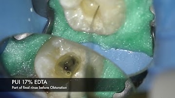 Endodontics: Auto-Transplantation