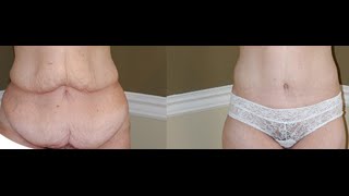 Post Weight Loss Body Contouring New Jersey screenshot 3