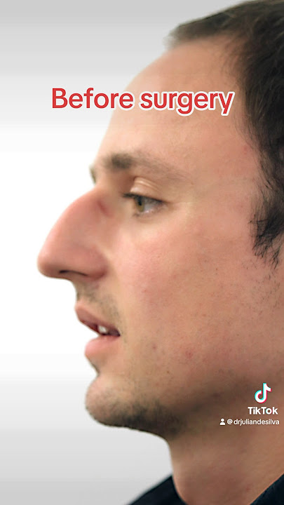 Incredible Male Rhinoplasty Results in only 6 weeks! #shorts #rhinoplasty