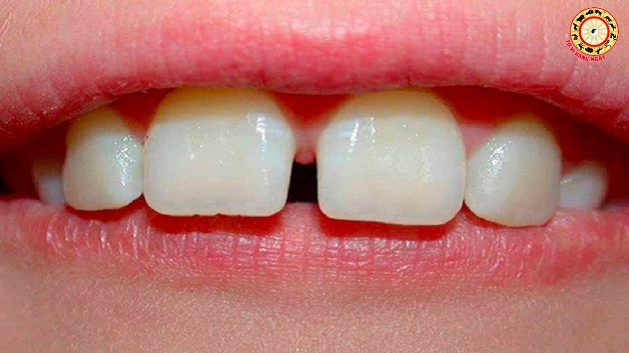 Какое расстояние между зубами