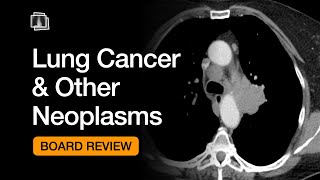 Lung Cancer & Other Neoplasms | Chest Radiology Board Review