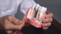 Dental Implant Problems and Solutions 