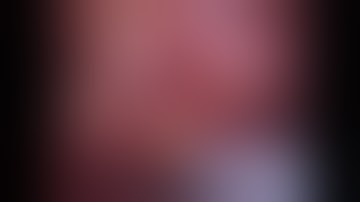 Robot assisted radical cystectomy with total intracorporeal urinary diversion - Dr. Seok Ho Kang