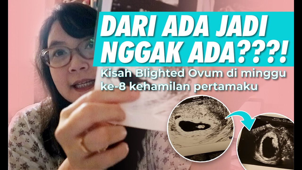 Hamil Kosong di Minggu ke-8 Setelah Ada Detak dan Janin??!! Kok Bisa??!!