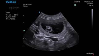 How to use Colour Doppler to differentiate circular structures