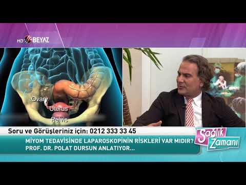 Laparoskopik Myomektomi, Laparoskopik Kistektomi Laparoskopik Histerektomi_Beyaz TV Polat Dursun