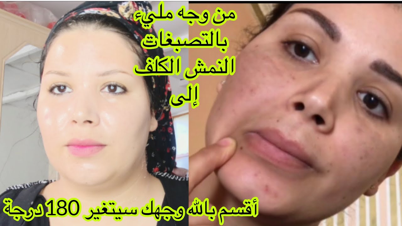 كيف غيرت بشرتي بوصفتين أقسم بالله أنقدو بشرتي من بعد ماتضمرت.بشرة مثل الزجاج في أسبوع بياض/صفاء