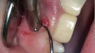 ひどい虫歯で歯茎から膿を出す のコピー Youtube