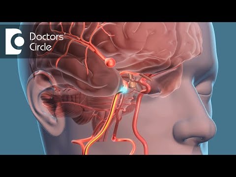 Video: Cerebral Aneurisme: Symptomer, Behandling, Konsekvenser, årsaker