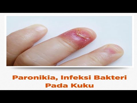 Video: 3 Cara Mengobati Paronikia