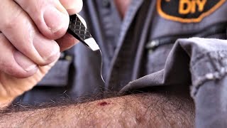 Splinter Removal - Steel Wire Splinter by Gavin Clark DIY 15,943 views 1 year ago 1 minute, 32 seconds