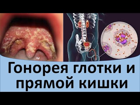 Гонорея глотки и прямой кишки