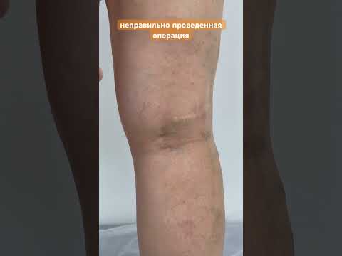 Варикоз на ногах. Рецидив варикоза. Сосудистая сетка. Флеболог Москва. Флеболог. Сосудистый хирург