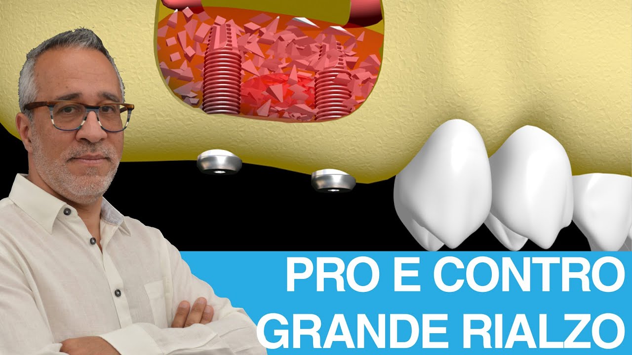 Pro e contro del grande rialzo di seno mascellare