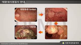 [시연용] b0011abko 대한대장항문학회대장내시경검사 안내요약판