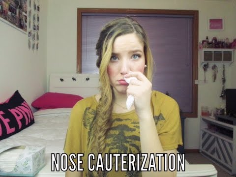 Nose Cauterization: My Experience
