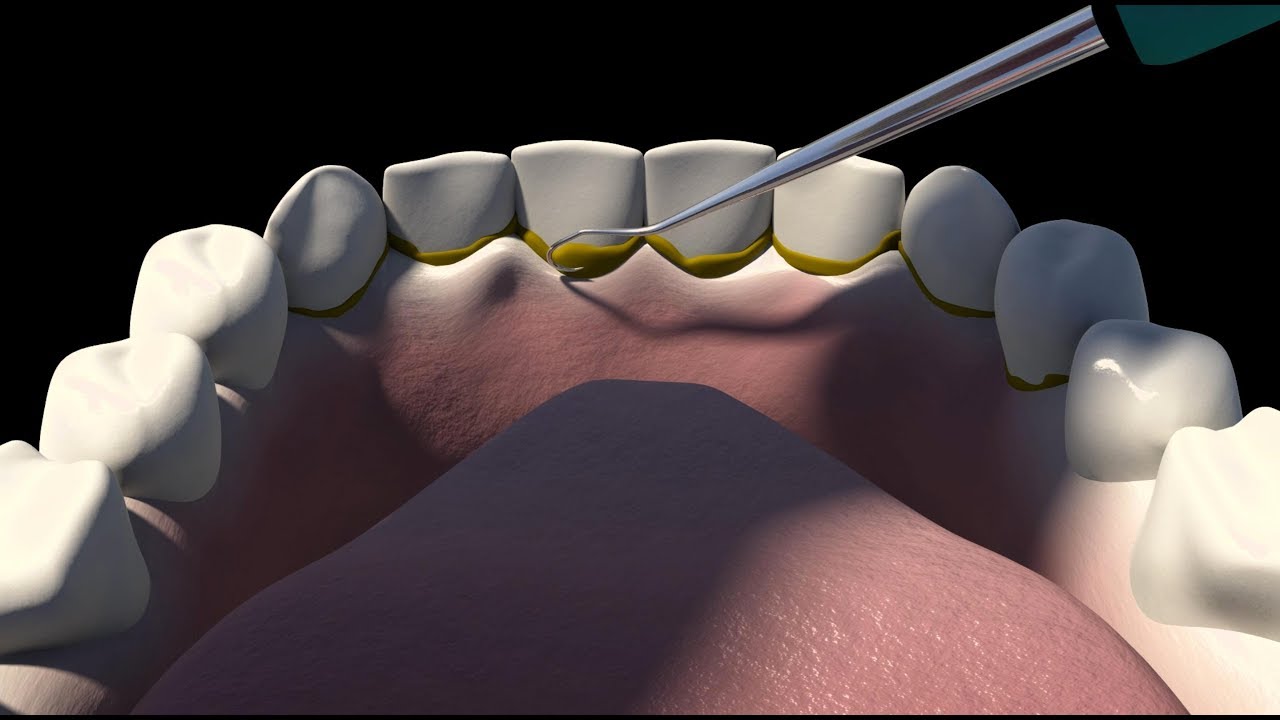 3d Animation Shows The Procedure For Dental Scaling NYC Dentist Dr 3d-animation-shows-the-procedure-for-dental-scaling-nyc-dentist-dr