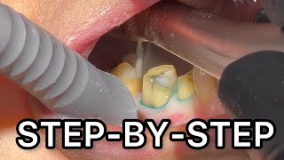 Upper Molar and Premolar Crown Preparation With Temporary Crowns