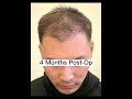 Hair transplant timeline 012 monthsbogota hairlines