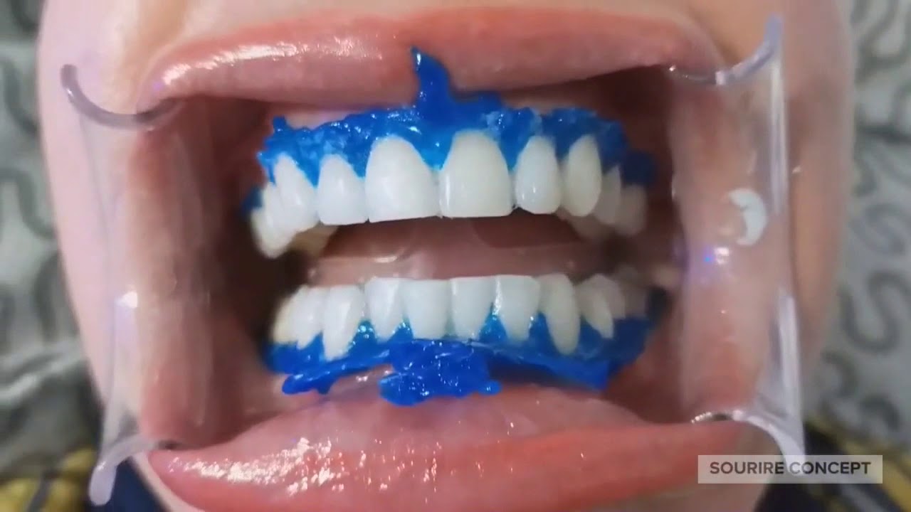 Blanchiment Dentaire ça vous parle YouTube