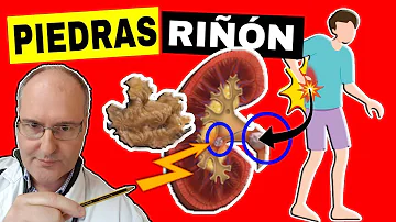 ¿Qué se siente al principio de un cálculo renal?