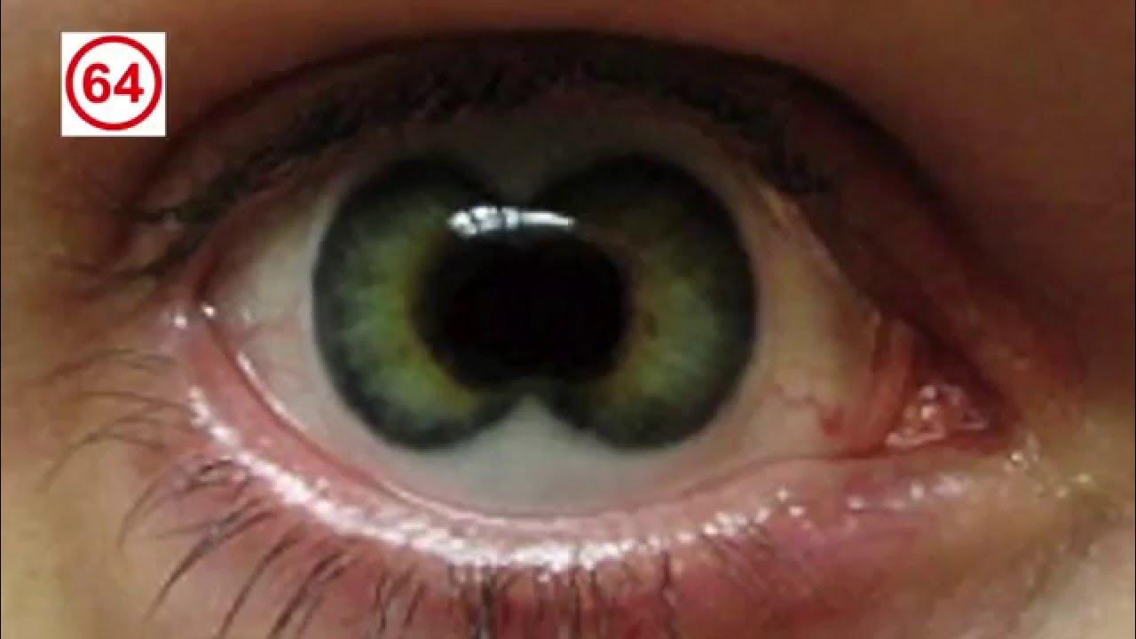 Поликория радужной оболочки. Несколько зрачков в глазу. Несколько зрачков в глазу. Pupula duplex двойной зрачок. Два зрачка как называется.