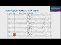 Особенности ЭЭГ при приступах с генерализованным началом. Ноговицын В Ю  Москва.