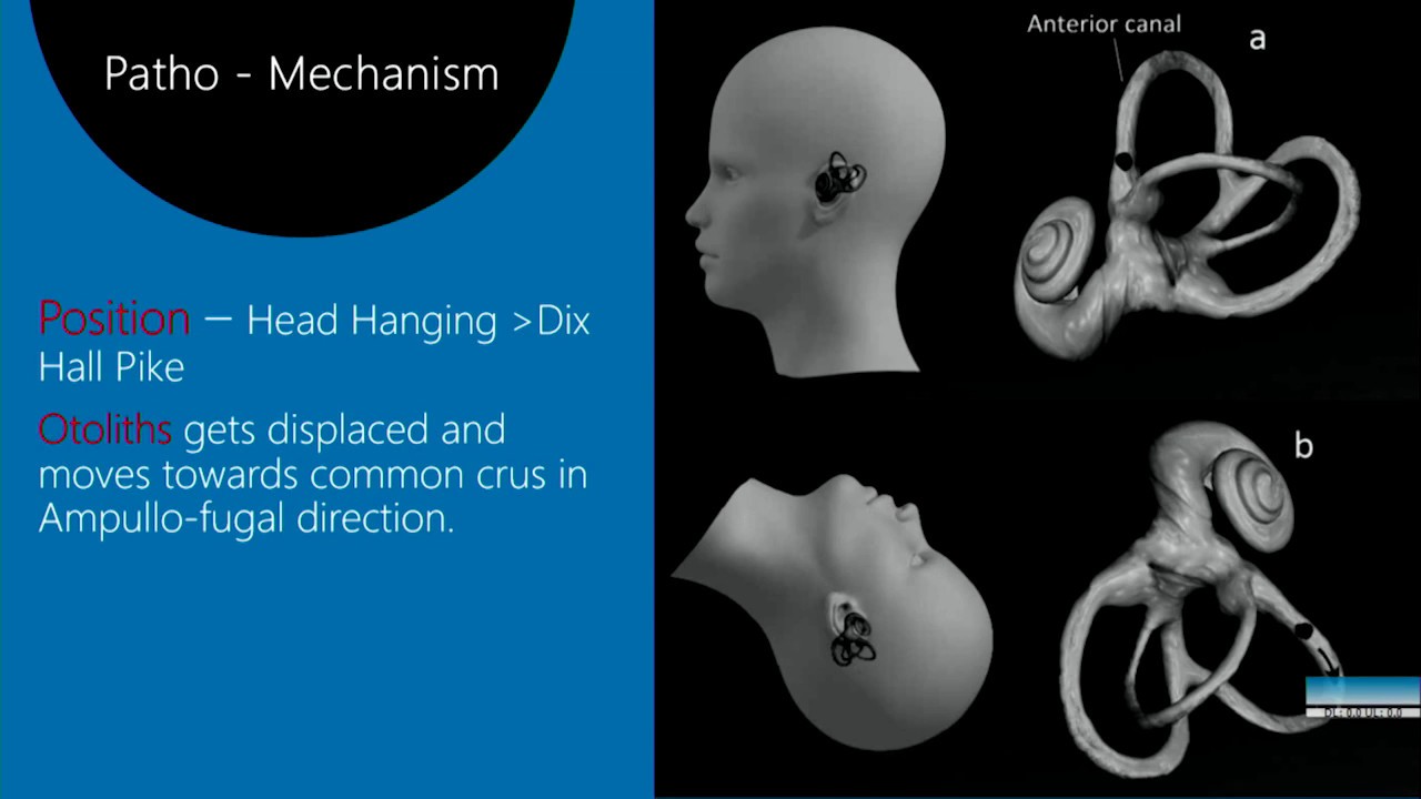 Anterior canal Benign paroxysmal positional vertigo or BPPV Dr