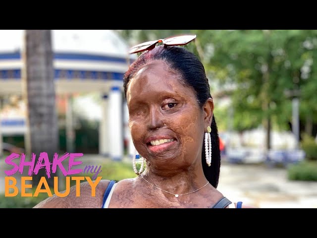 I Was Attacked With Acid - But I Still Feel Beautiful | SHAKE MY BEAUTY class=