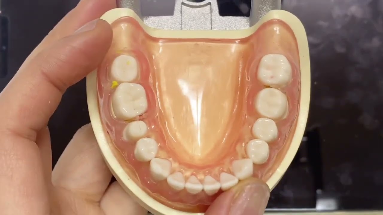 덴쳐 임프 (denture imp) 잘 나와야하는 부위