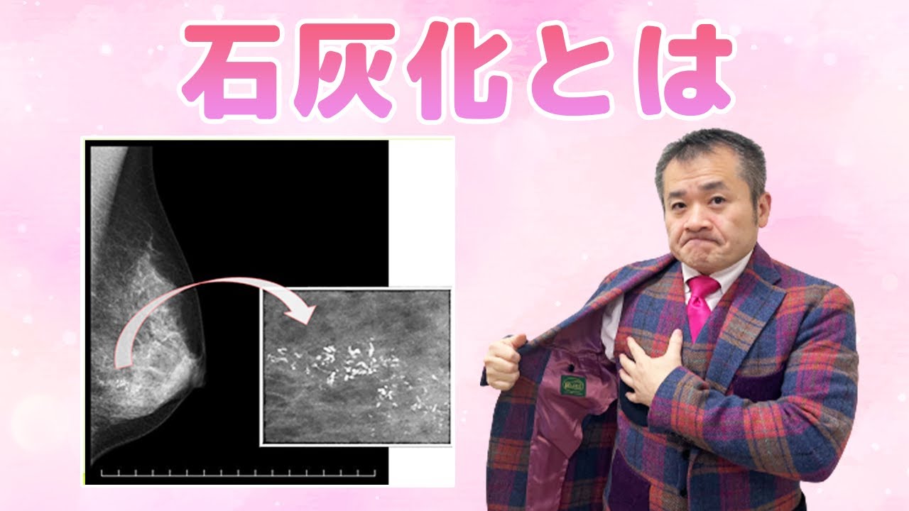 Download マンモグラフィーの石灰化とマンモ