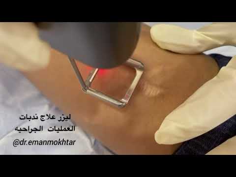 ليزر علاج ندبات العمليات الجراحيه