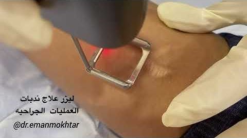 ليزر علاج ندبات العمليات الجراحيه