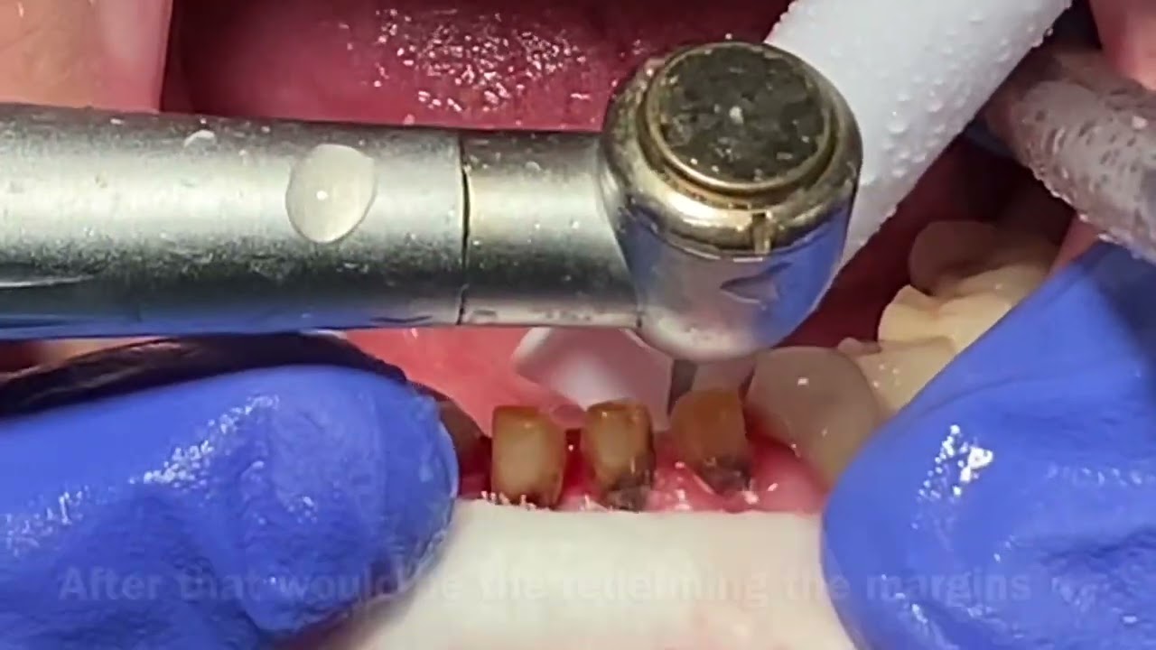 How to make dental crowns YouTube