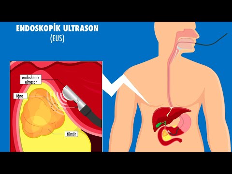 Endoskopik ultrason nedir? - Prof. Dr. Alper Yurci (Gastroenteroloji Uz.)