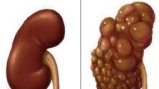 Don't Die Young Please Stop Doing These 5 Things It Harms Your Kidney