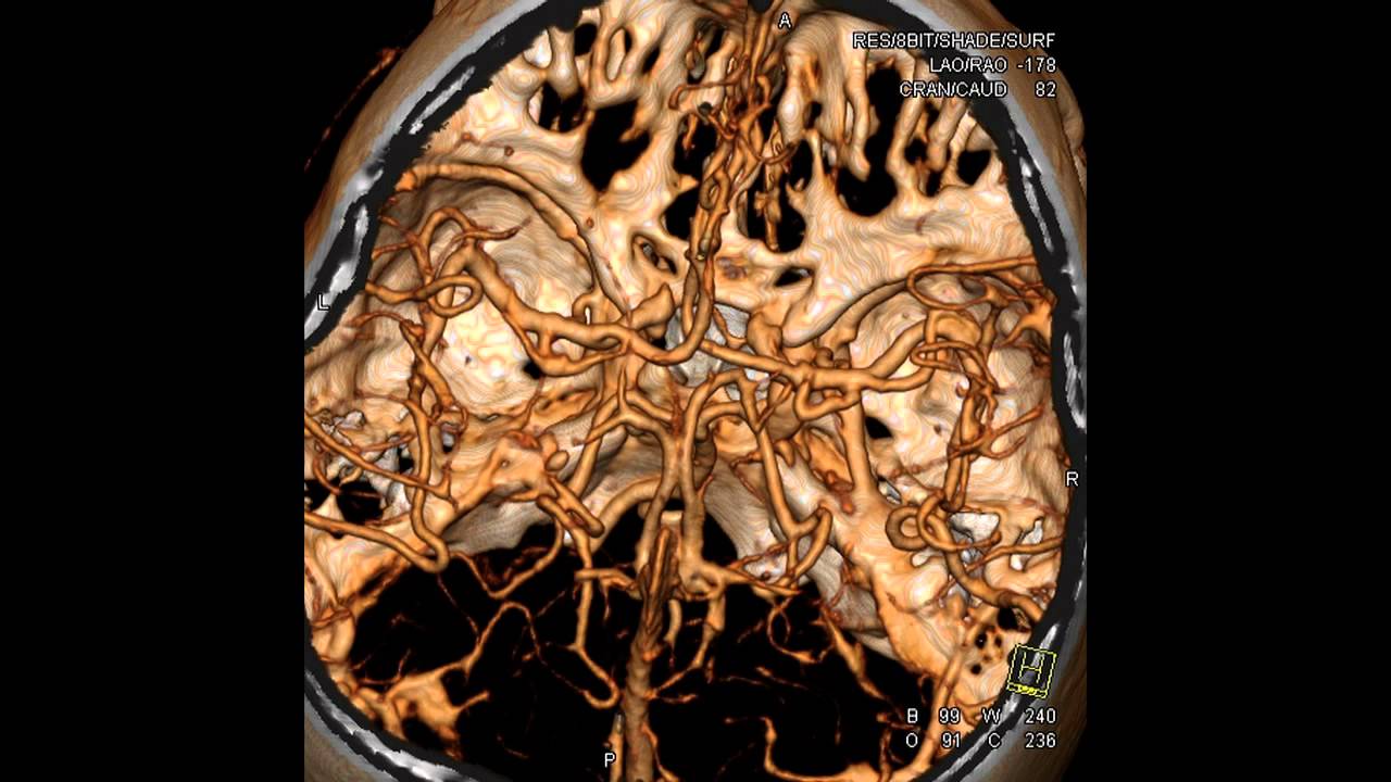 Кт сосудов головы и шеи. Кт томограмма головного мозга. Мрт ангиография артерий головного мозга. Кт ангиография аневризма головного мозга.