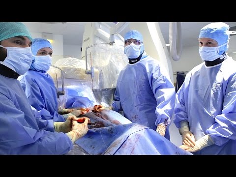 Video: Aorta - Behandling Af Aorta Med Folkemedicin Og Metoder