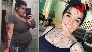 Shes Been Covered In Birthmarks Her Whole Life Now, This Teen Is Owning Her Condition