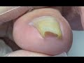 Very special shape nail repair - Nail Skill Teaching by Mr toenail