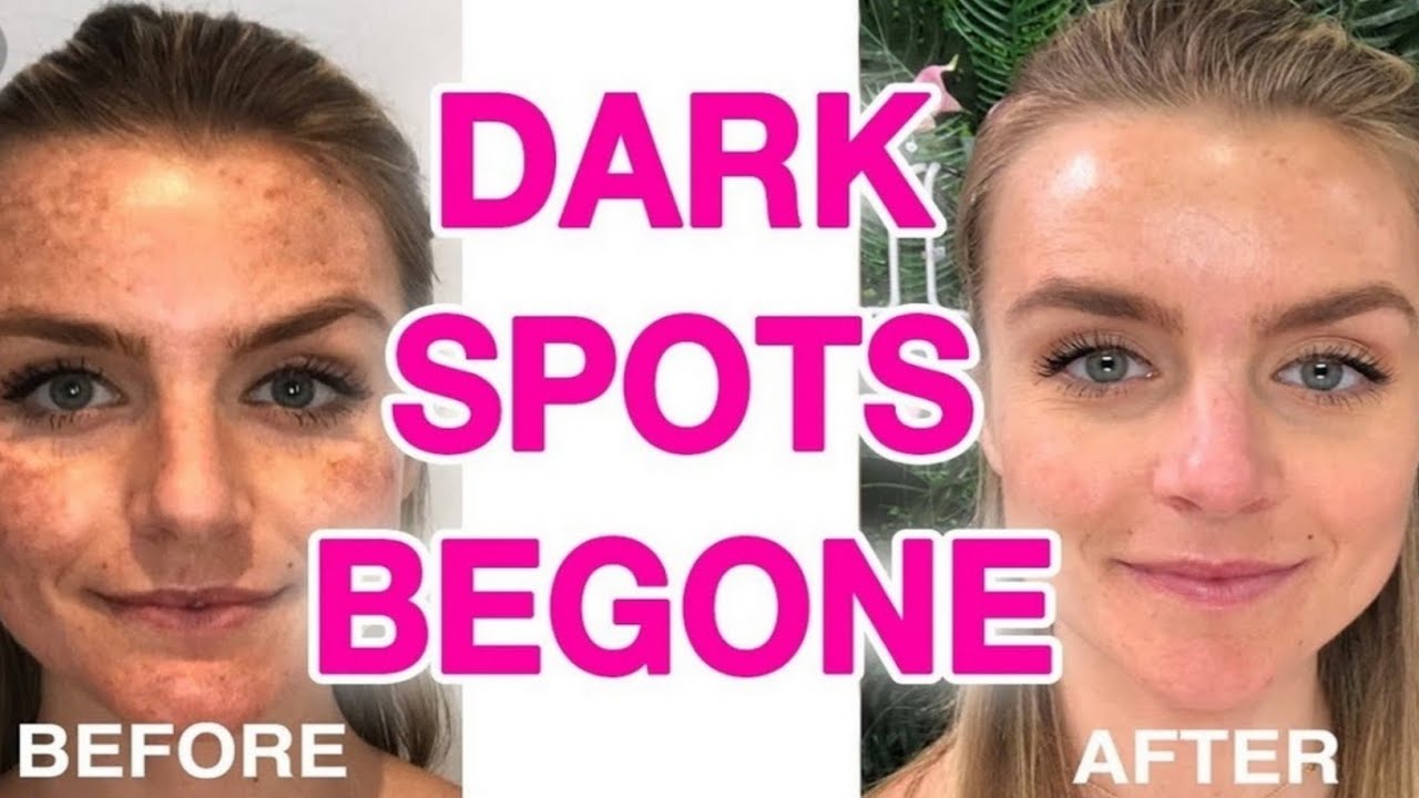 Face Acne Treatment Face Acne Ki Dua Chary Pr Danay Ho Ya Chaiyan