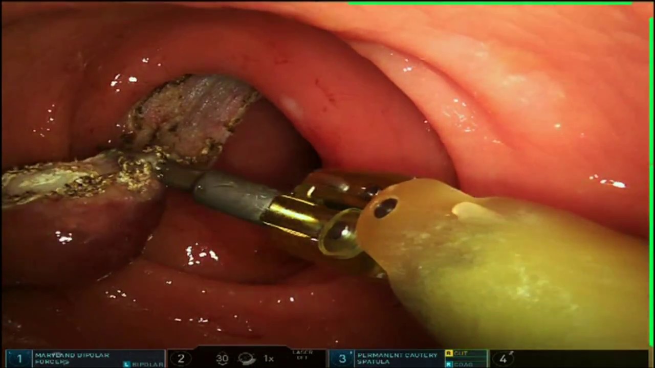 Robotic Transanal Minimally Invasive Surgery (R-TAMIS) with da Vinci Xi