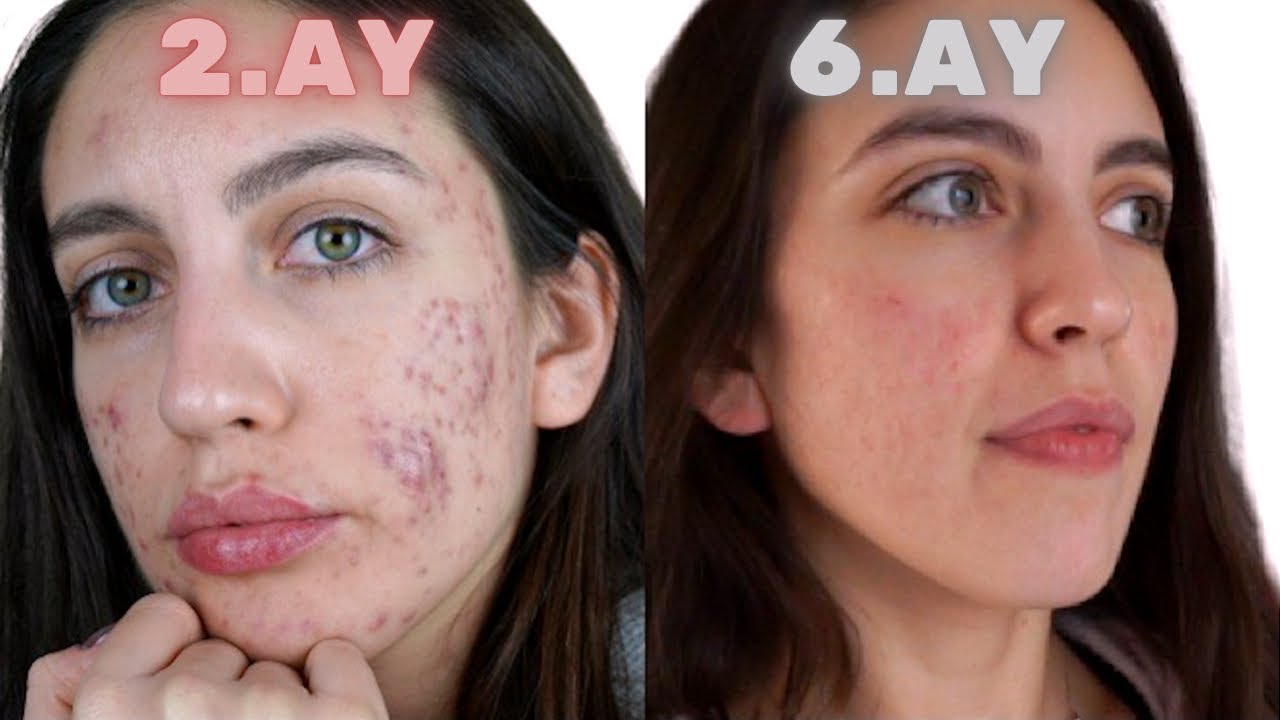 roaccutane