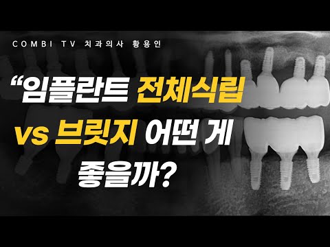   전악무치악 부분무치악 전체 임플란트를 해야 할까 브릿지를 해야 할까