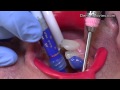 Invisalign - part1